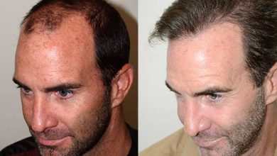 Hair Transplant