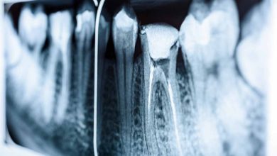 Root Canal: A Comprehensive Guide to Dental Care