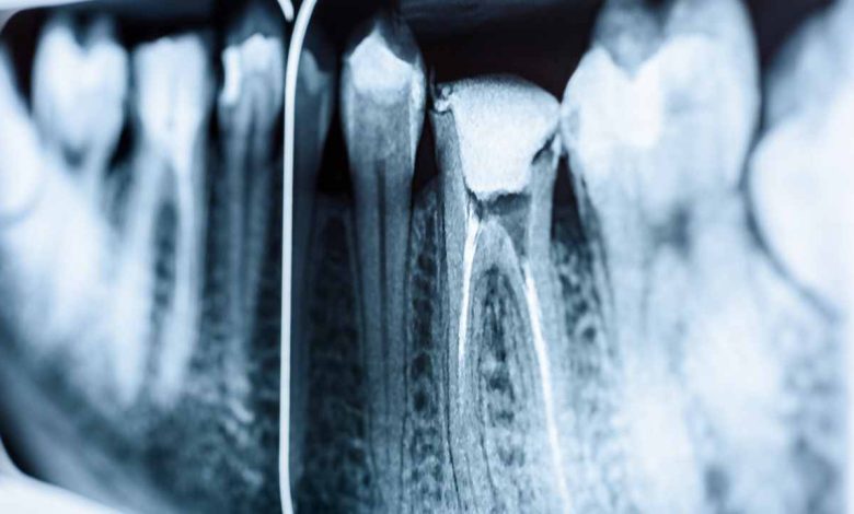 Root Canal: A Comprehensive Guide to Dental Care