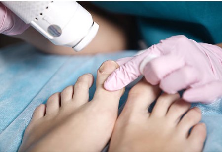 How Effective Is Laser Toenail Treatment for Fungus