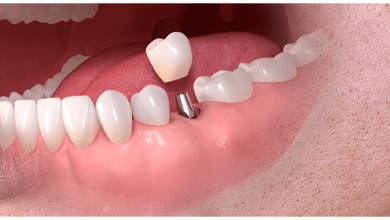 Dental Implants