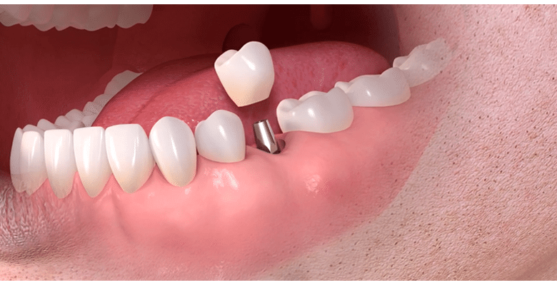 Dental Implants