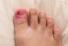 How Does Ingrown Toenail Matricectomy Relieve Discomfort Effectively