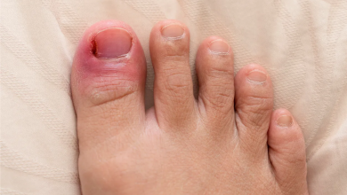 How Does Ingrown Toenail Matricectomy Relieve Discomfort Effectively