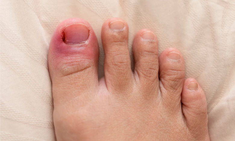 How Does Ingrown Toenail Matricectomy Relieve Discomfort Effectively